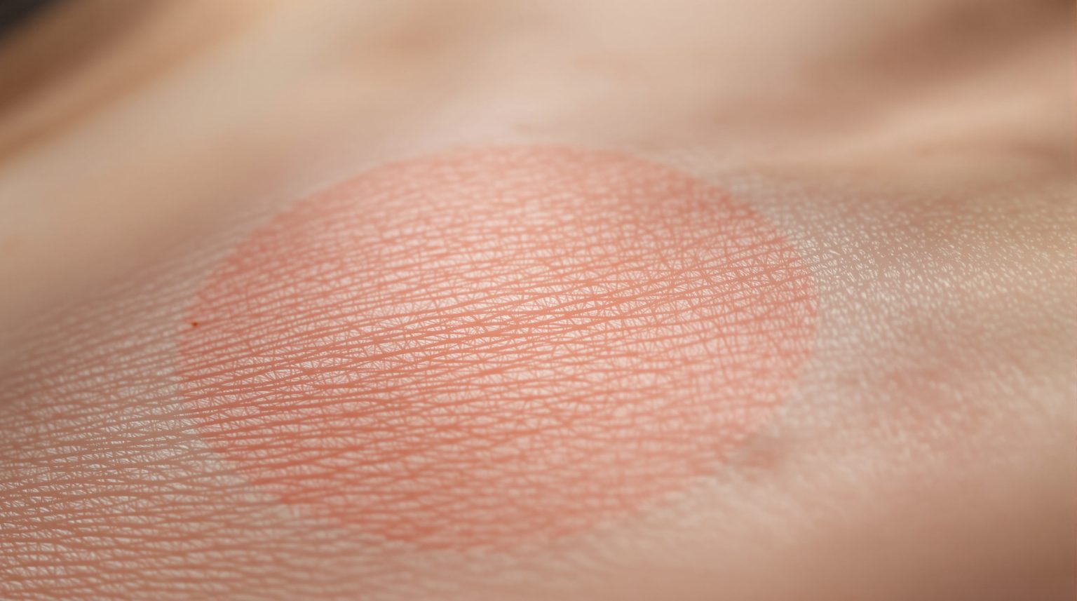 Fil résorbable qui ressort cicatrice : Découvrez tout sur ce traitement novateur pour une cicatrisation optimale